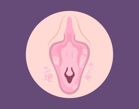 Can You Get Pimples on Your Vulva?