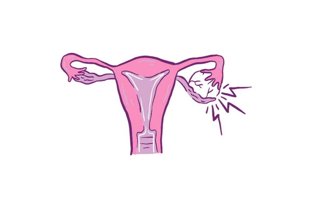 polycystic ovary syndrome, excess hair growth, male hormones