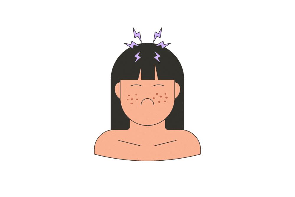 Woman with adult acne caused by stress.